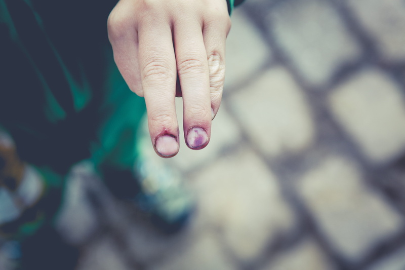 pattern, outdoors, nail, finger, injury, ring, s, point, person, skin, hand, forward, close-up, human body part, wrinkled, focus on foreground, bruise