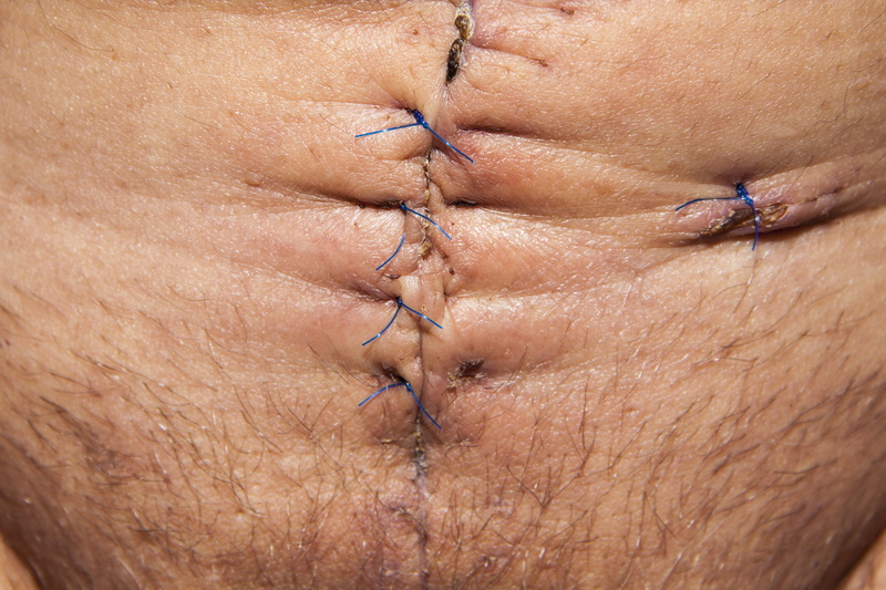 human joint, scar, body part, surgeon, adult, medical, healthcare and medicine, operation, surgical scar, in the body, healthy lifestyle, op, tummy, therapy