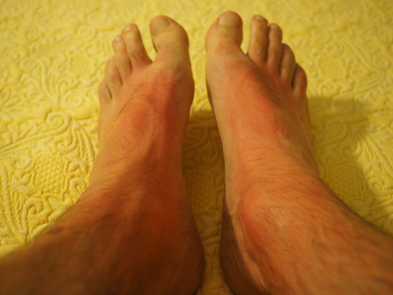 people, flushed, barefoot, human Leg, human limb, risk, textile, 4K, skin cancer, person, human Toe, white, s, dermatology, relaxation, hand, indoors