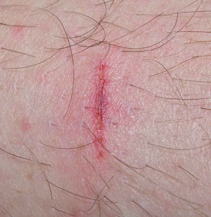 real people, body part, Wound, time heals all wounds, close-up, human hair, place of miracles, Injury, pain, one person, people, anatomy, frisch, blood