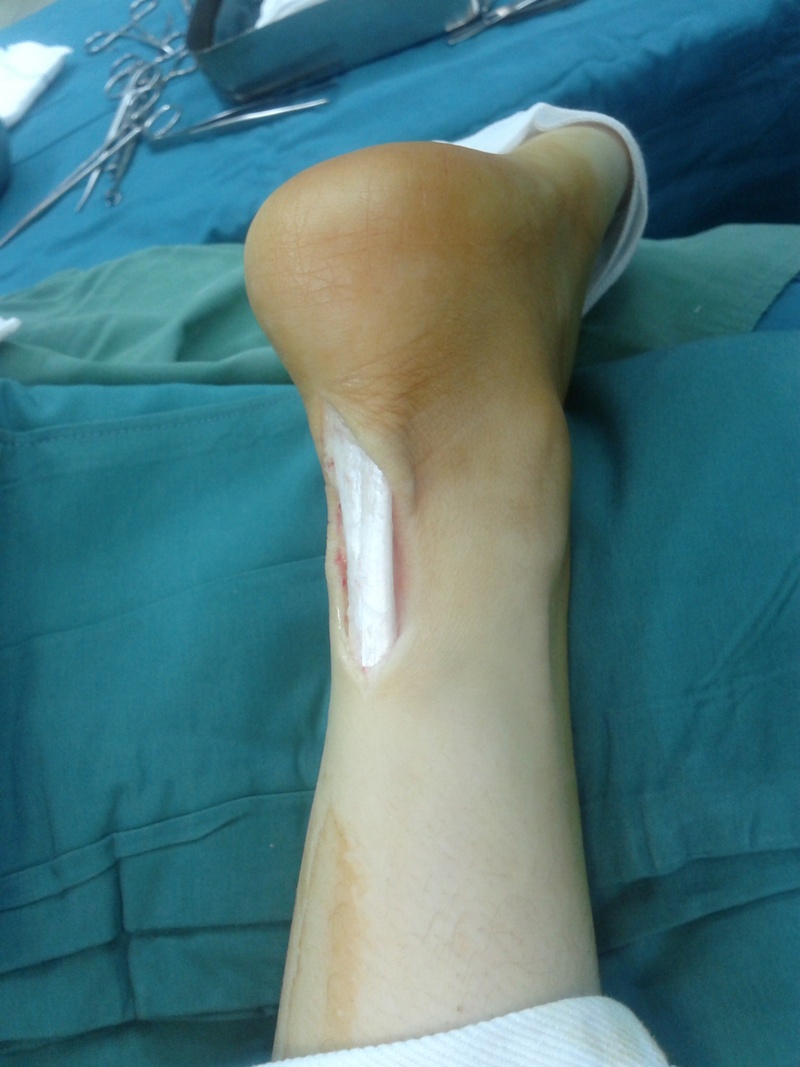 1080P, one person, limb, operation, leg, injury, rupture, anatomy, indoors, pain, recovery, high angle view, human body part, human leg, healthcare and medicine