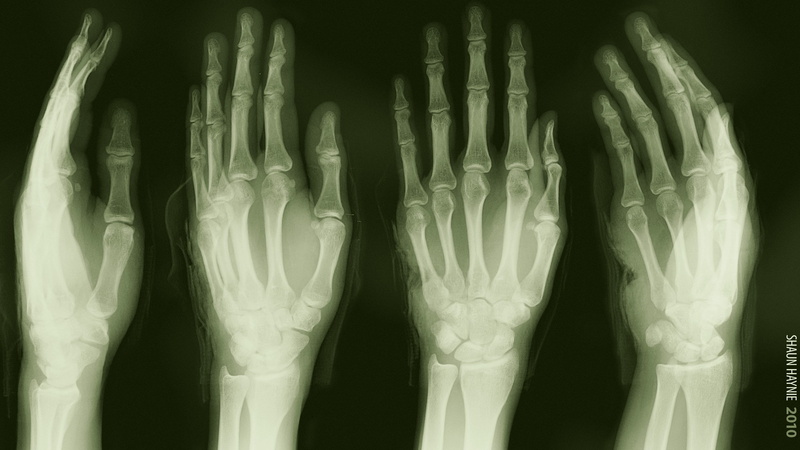 dark, hand, human finger, human body part, healthcare and medicine, body part, human bone, medical condition, 2K, people, fracture, analyzing, medical exam