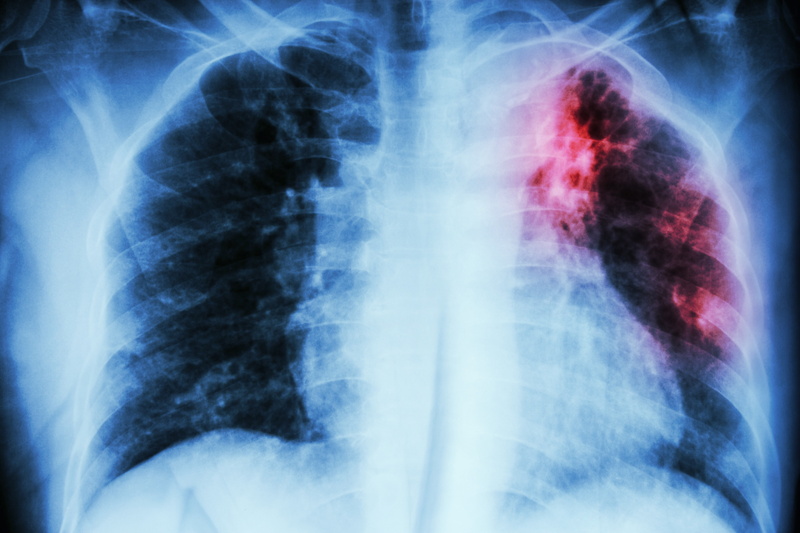 radiography, stain, infection, 5K, lungs, disease