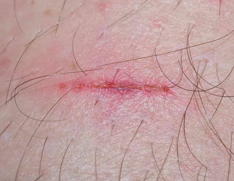 extreme close-up, 2K, skin, one person, human skin, physical injury, pink color, full frame, unrecognizable person, day, frisch, scratched, human hair